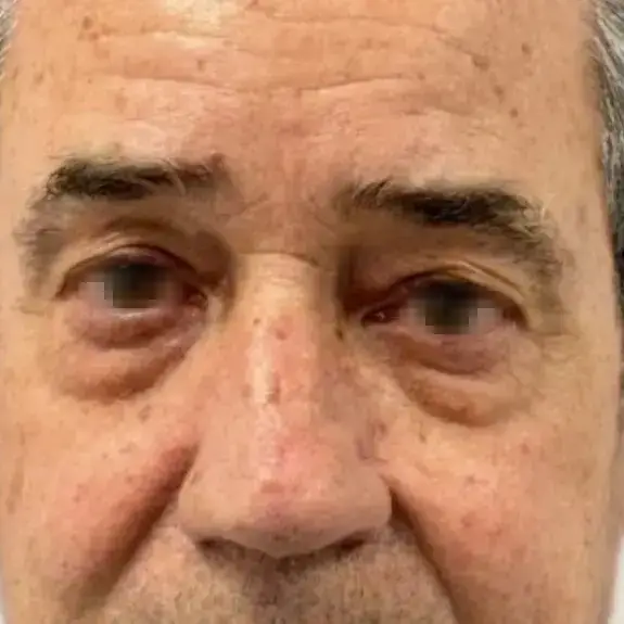 Antes de Antes y después de una Blefaroplastia