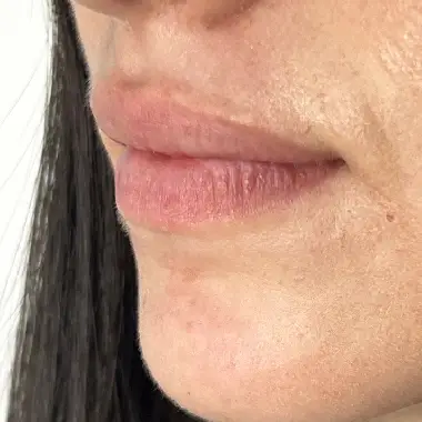 Antes de Micropigmentación de Labios