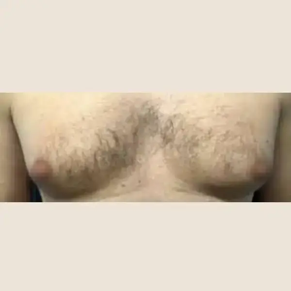 Antes de Gynecomastia