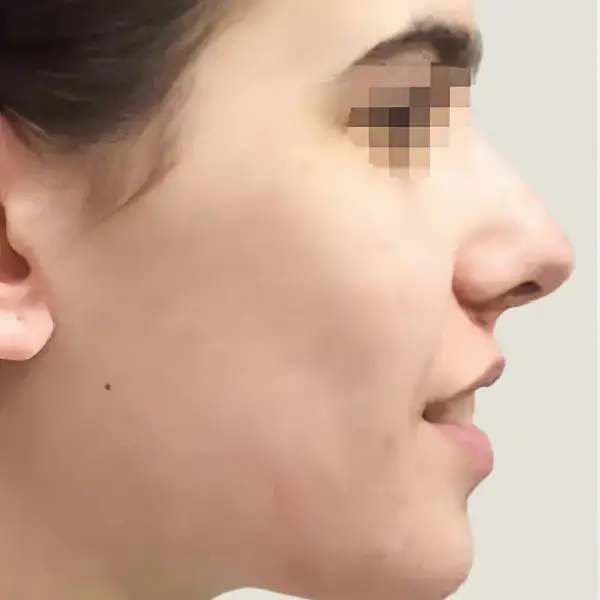 Antes de Rinoplastia secundaria