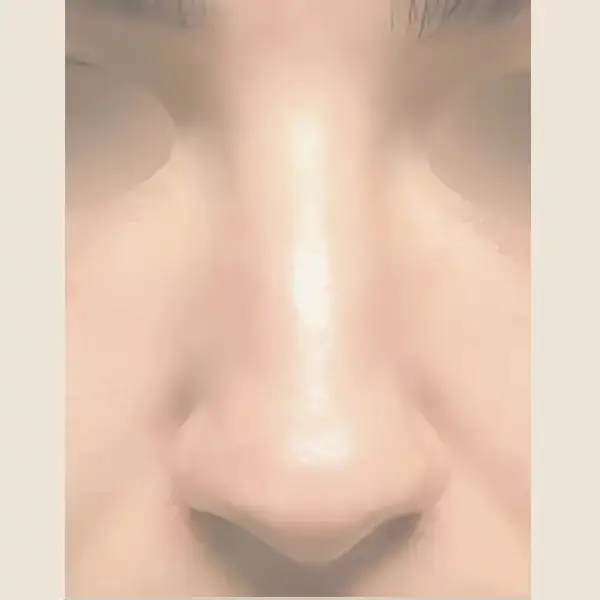 Antes de Rinoplastia secundaria