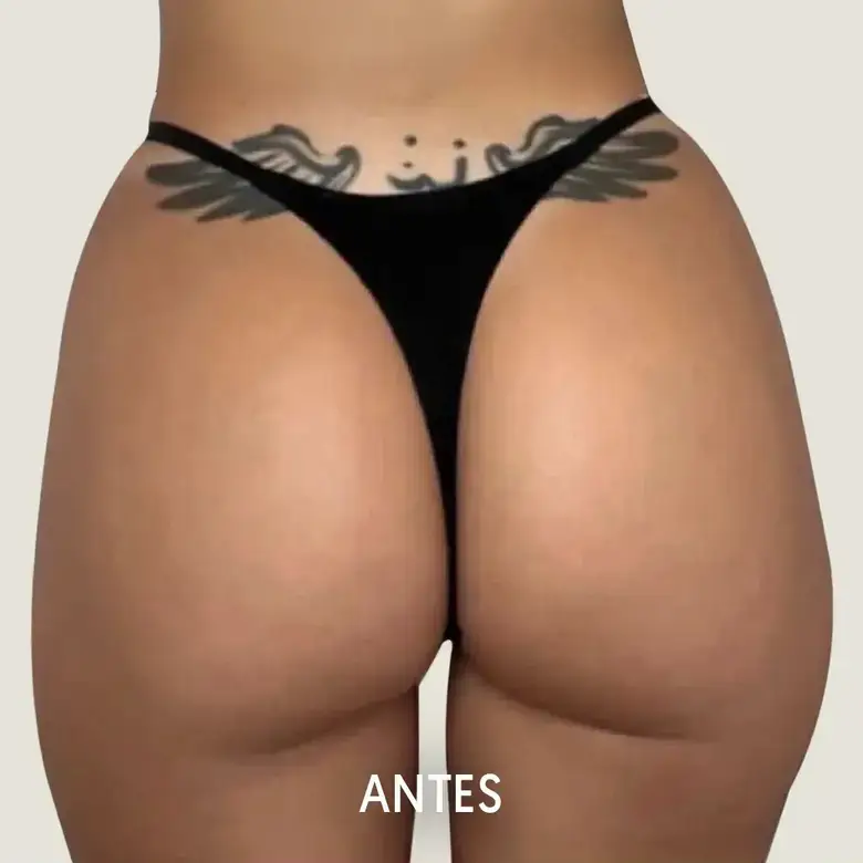 Antes de Hip Dips