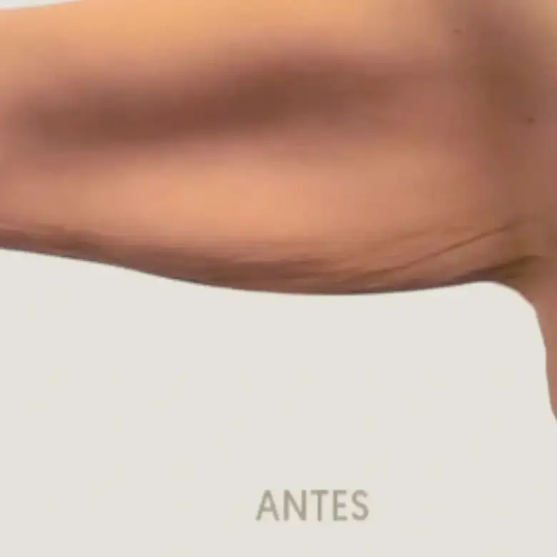 Antes de Brachioplasty