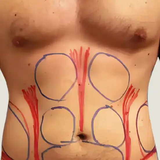 Antes de Lipoescultura