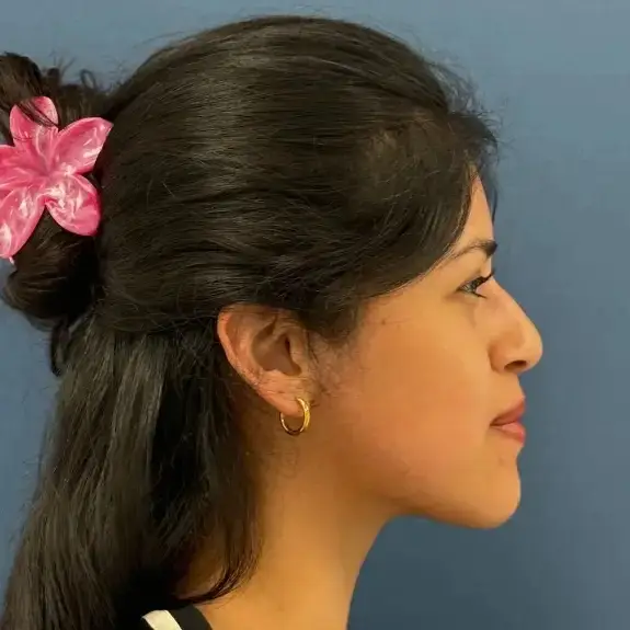 Antes de Rinoplastia Ultrasonic Rhinoplasty
