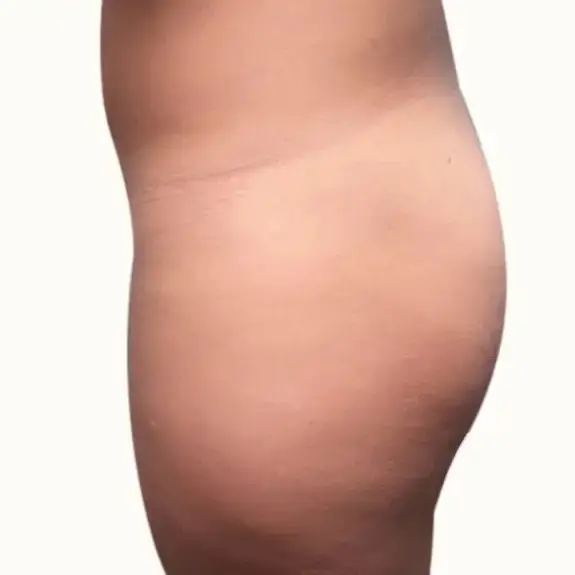 Antes de Buttock augmentation