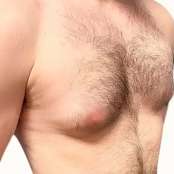 Antes de Gynecomastia