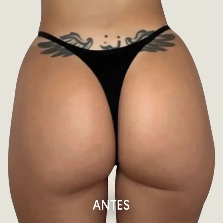 Antes de Buttock augmentation