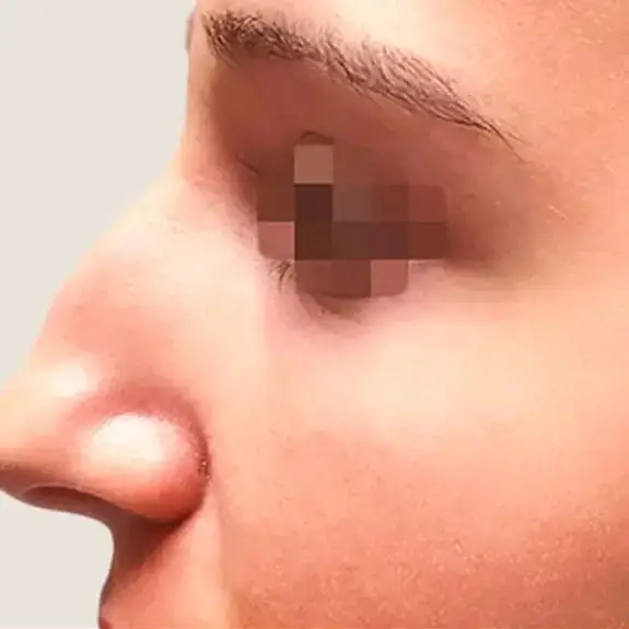 Antes de Ultrasonic Rhinoplasty