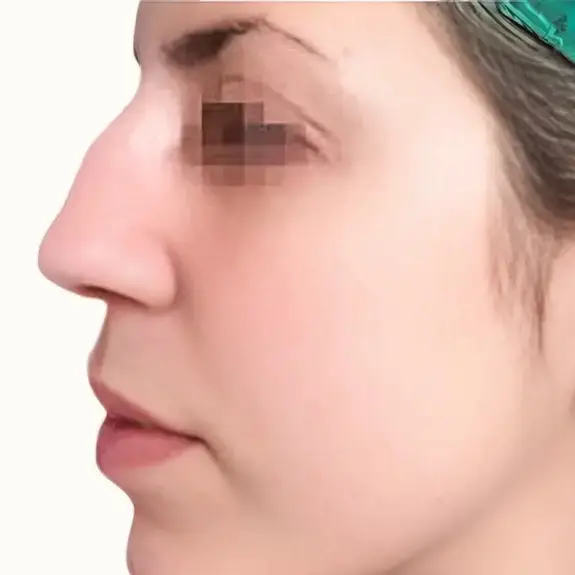 Antes de Ultrasonic Rhinoplasty