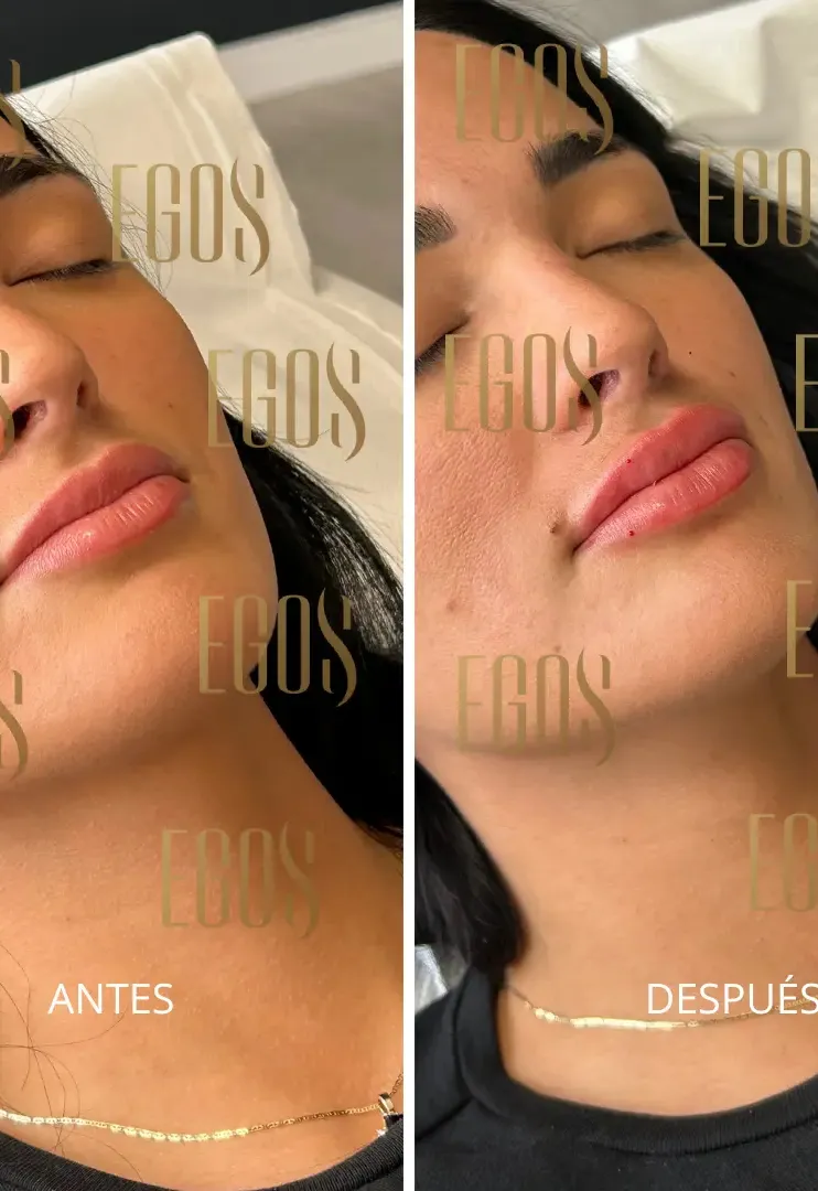 Claudia Bavel y su tratamiento rejuvenecimiento de la mirada