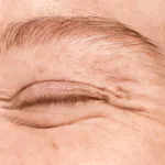 Eliminar arrugas de expresión: luce 10 años más joven