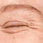 Eliminate expression lines: Look 10 years younger