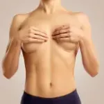 Corrección de cicatriz periareolar en aumento de pecho