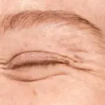 Eliminar arrugas de expresión: luce 10 años más joven