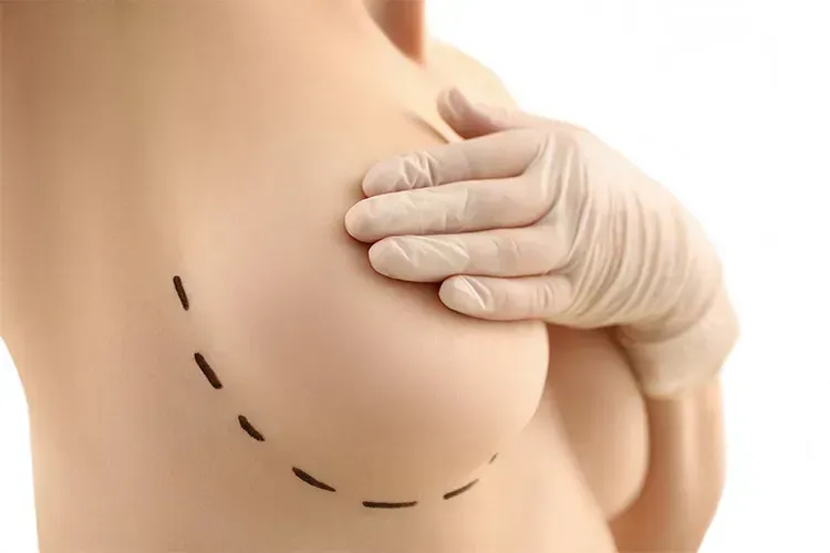 Com millorar la cicatriu d'un augment de pit