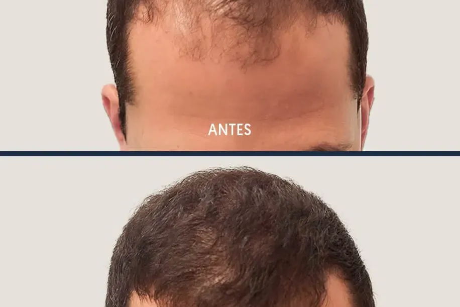 Caída de cabello por estrés: Causas, síntomas y cómo prevenirlo