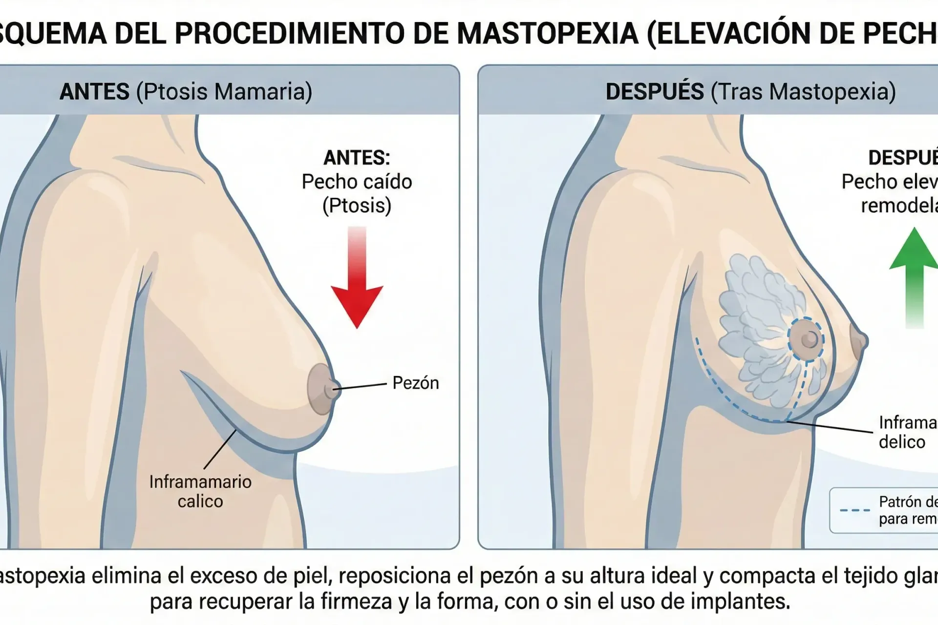 Mastopexia sin prótesis o con implantes: diferencias, resultados y cuál elegir