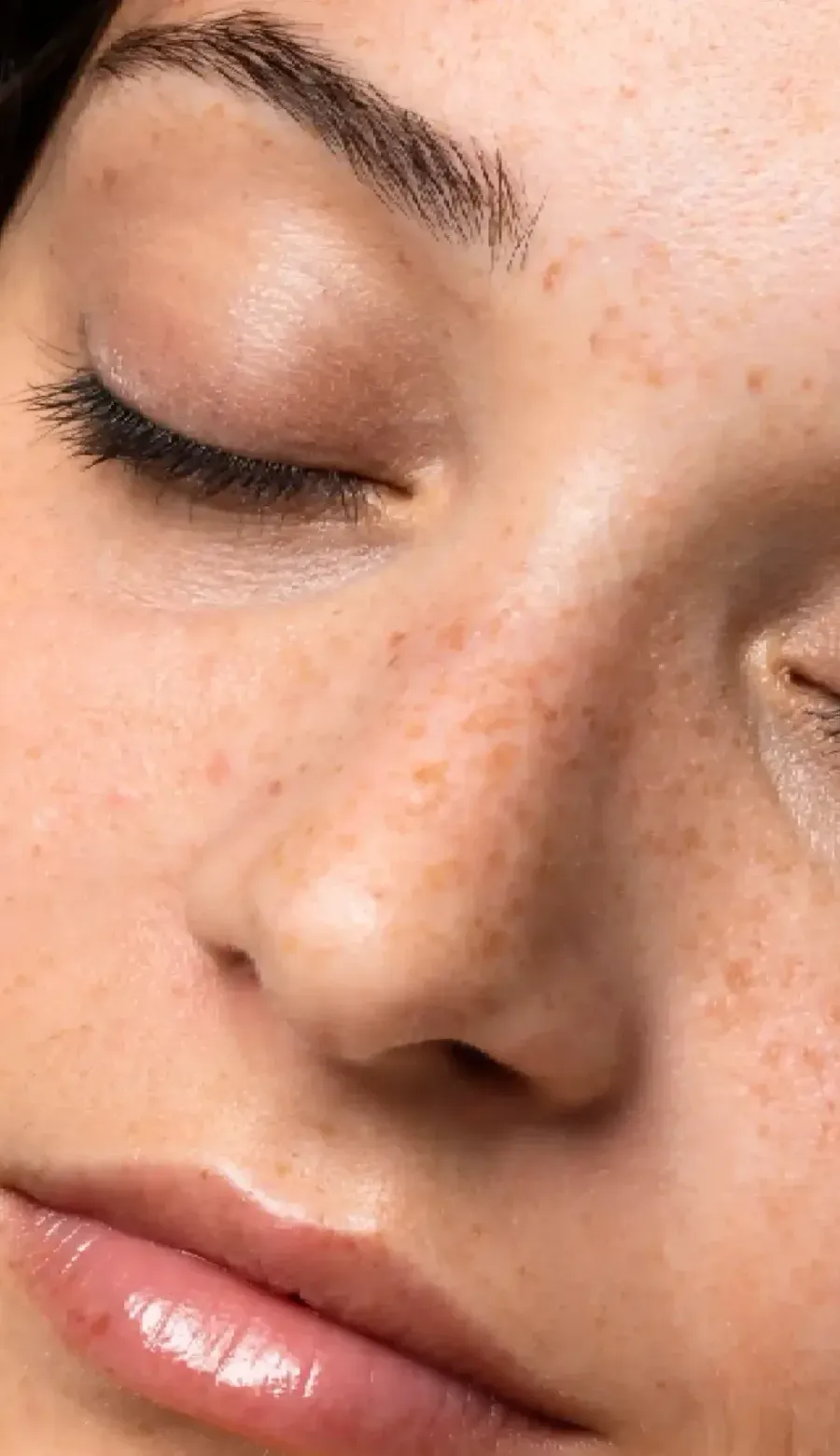 Información de la Medicina estética - Relleno de ojeras