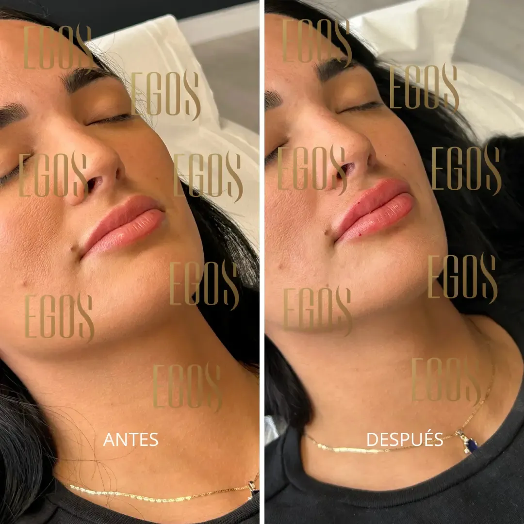 Claudia Bavel and her eye-rejuvenation treatment