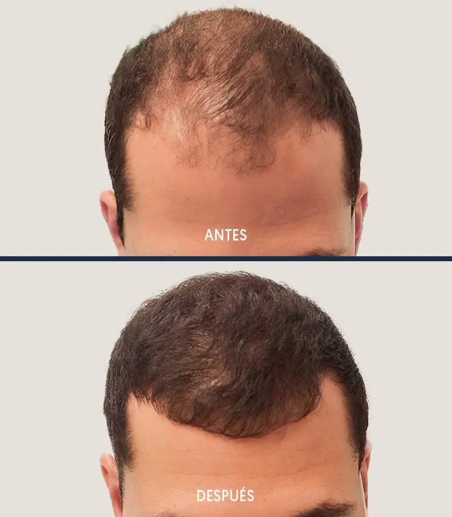 Caída de cabello por estrés: Causas, síntomas y cómo prevenirlo