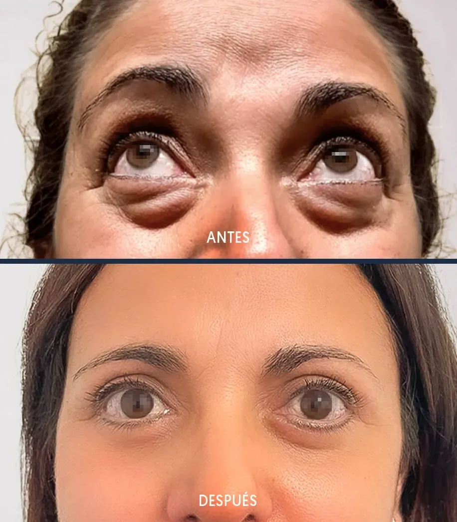 ¿Pueden volver a salir las bolsas tras la blefaroplastia?