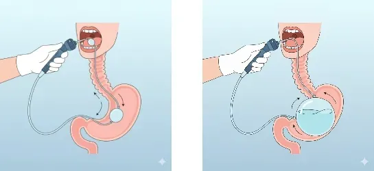 Com funciona el baló gàstric?