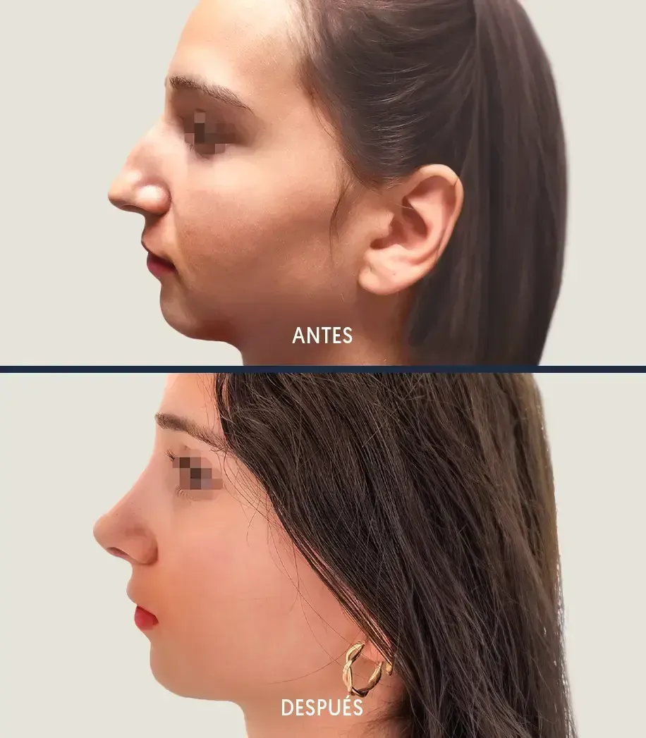 Nariz Aguileña: Cómo cambiar la forma sin perder tu esencia