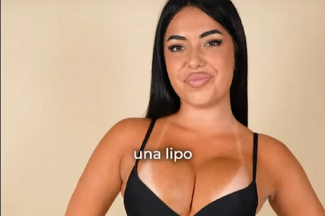 Carla gets a buttock augmentation