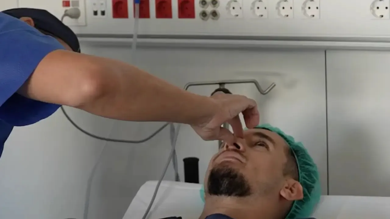 En Miguel ens parla de la seva rinoplàstia