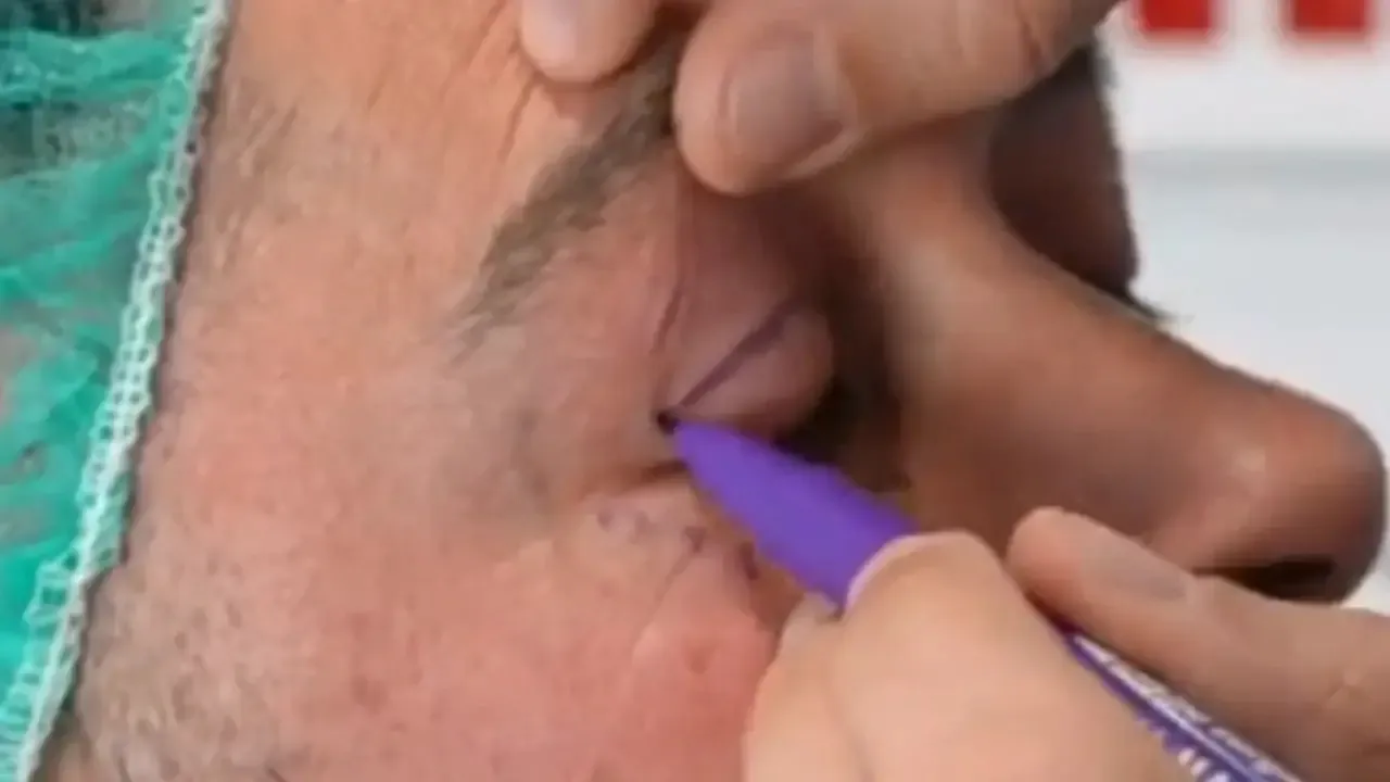 Vicente experiencia y caso real de blefaroplastia