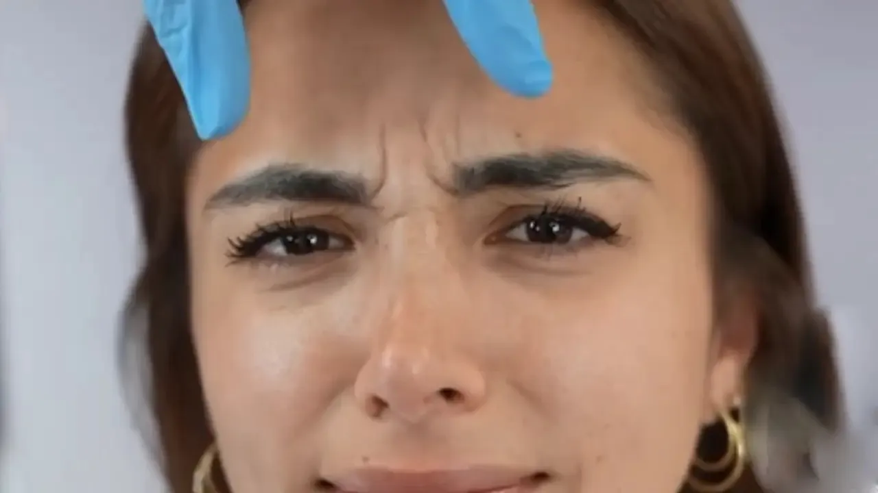 Sandra Pica tractament d'àcid hialurònic