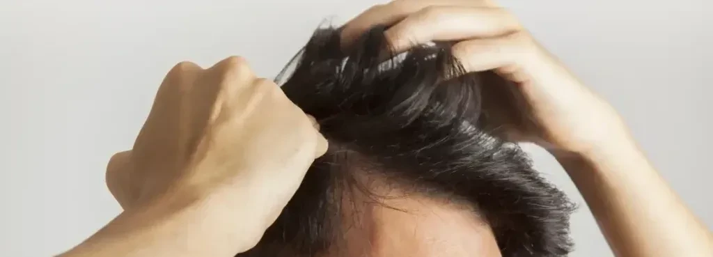 Imatge de Cirurgia capil·lar: Tota la informació