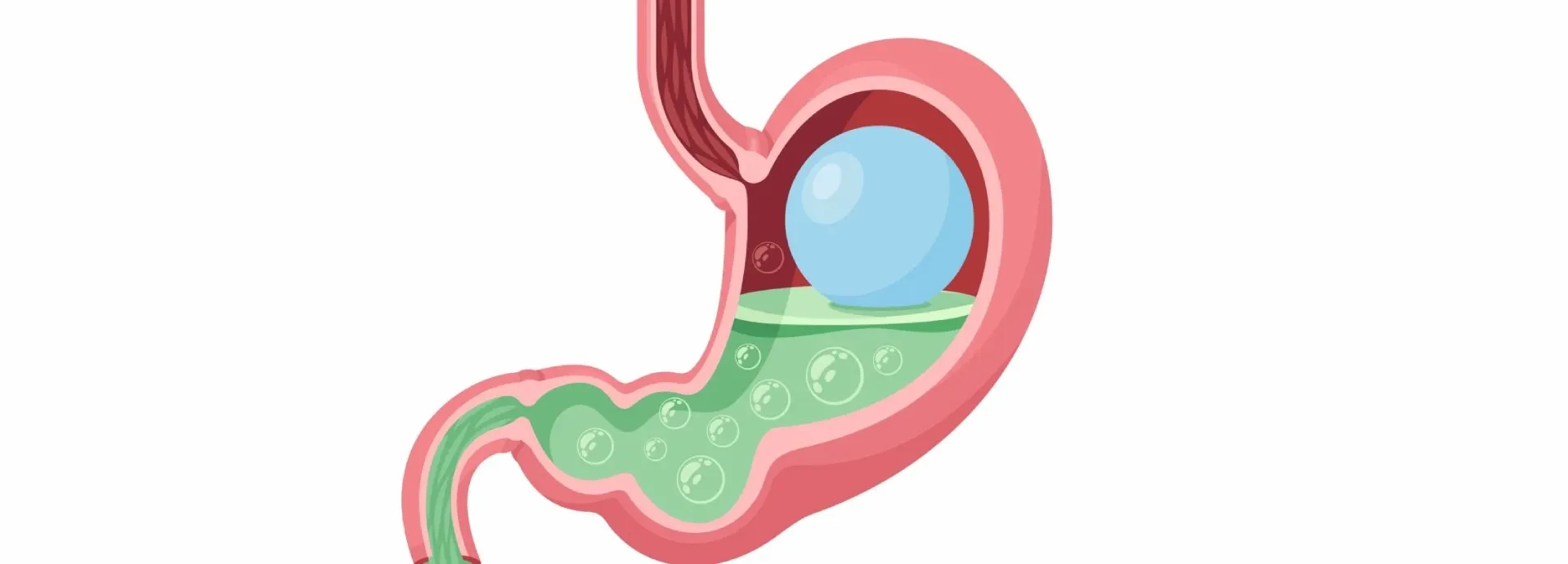 Imagen de ¿Cómo funciona el balón gástrico?