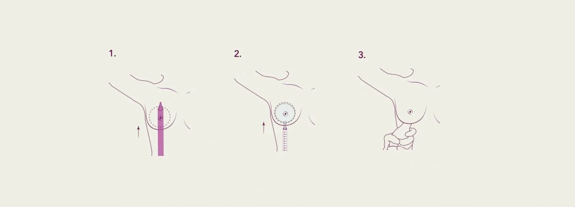 Image of Preservé: The Minimalist Technique that cares for your breast sensitivity
