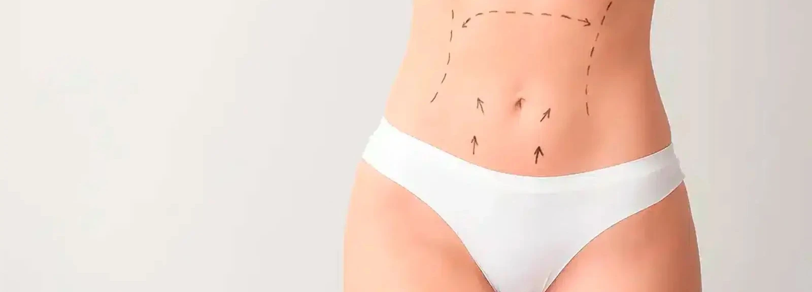 Imagen de Evolución de la cicatriz de una abdominoplastia