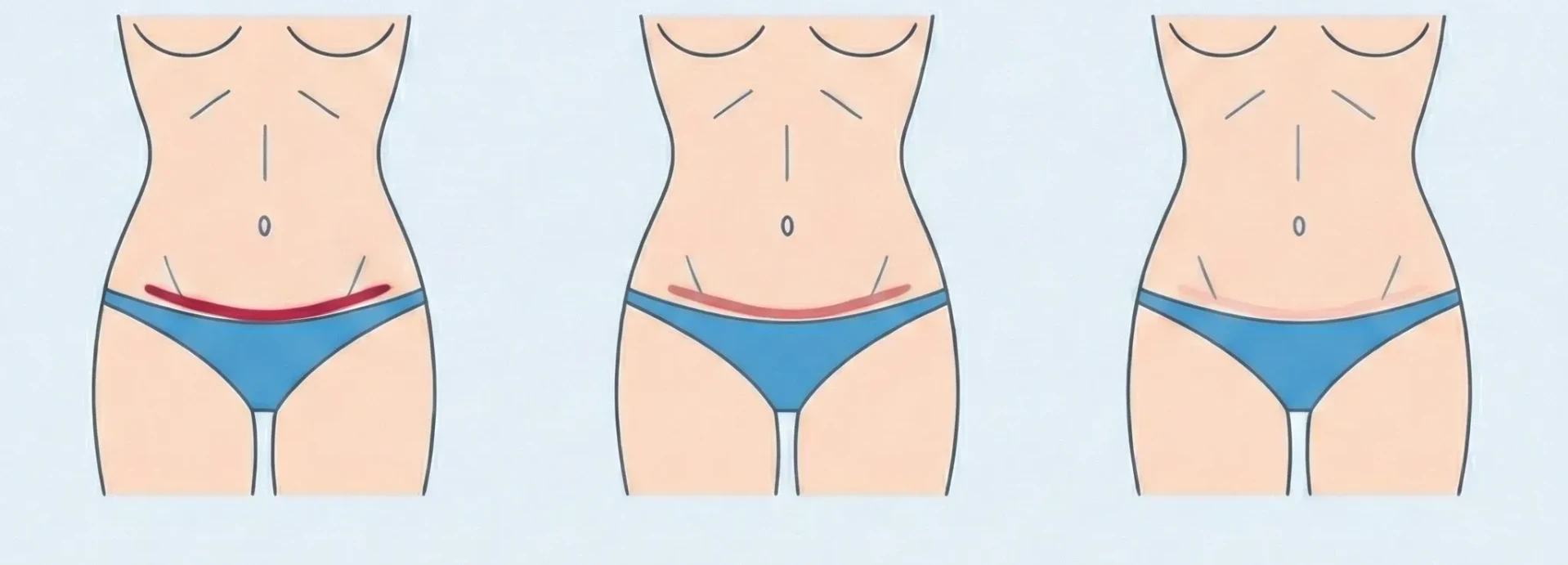 Imagen de Cicatriz de abdominoplastia: cuidados y situaciones reales