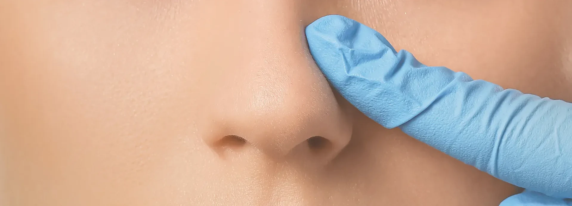 Imatge de Diferència entre rinoplàstia ultrasònica i rinoplàstia tradicional