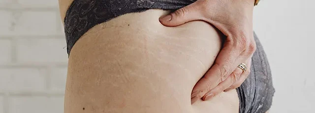 Imagen de Remedios para las estrías