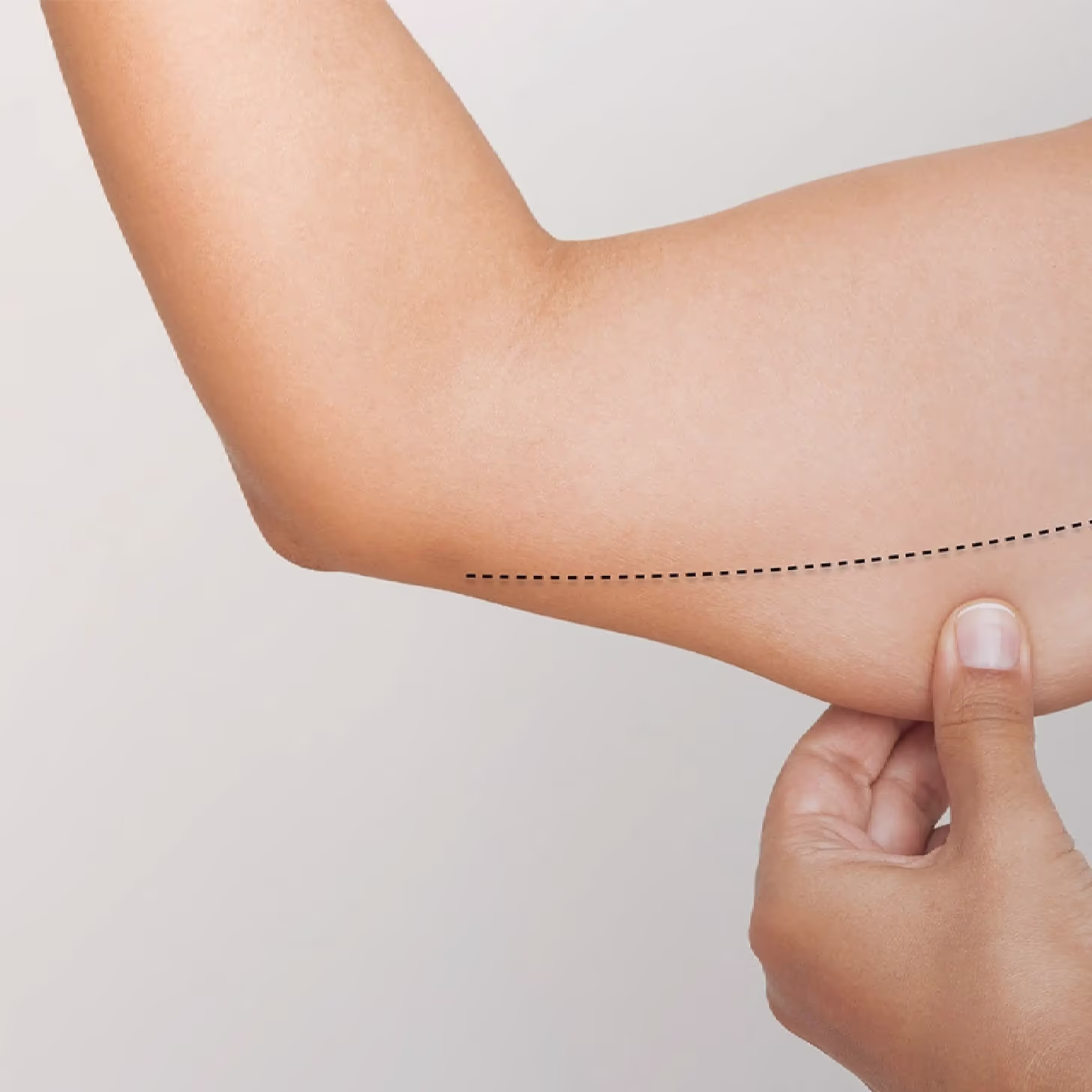 Ideal candidate for brachioplasty
