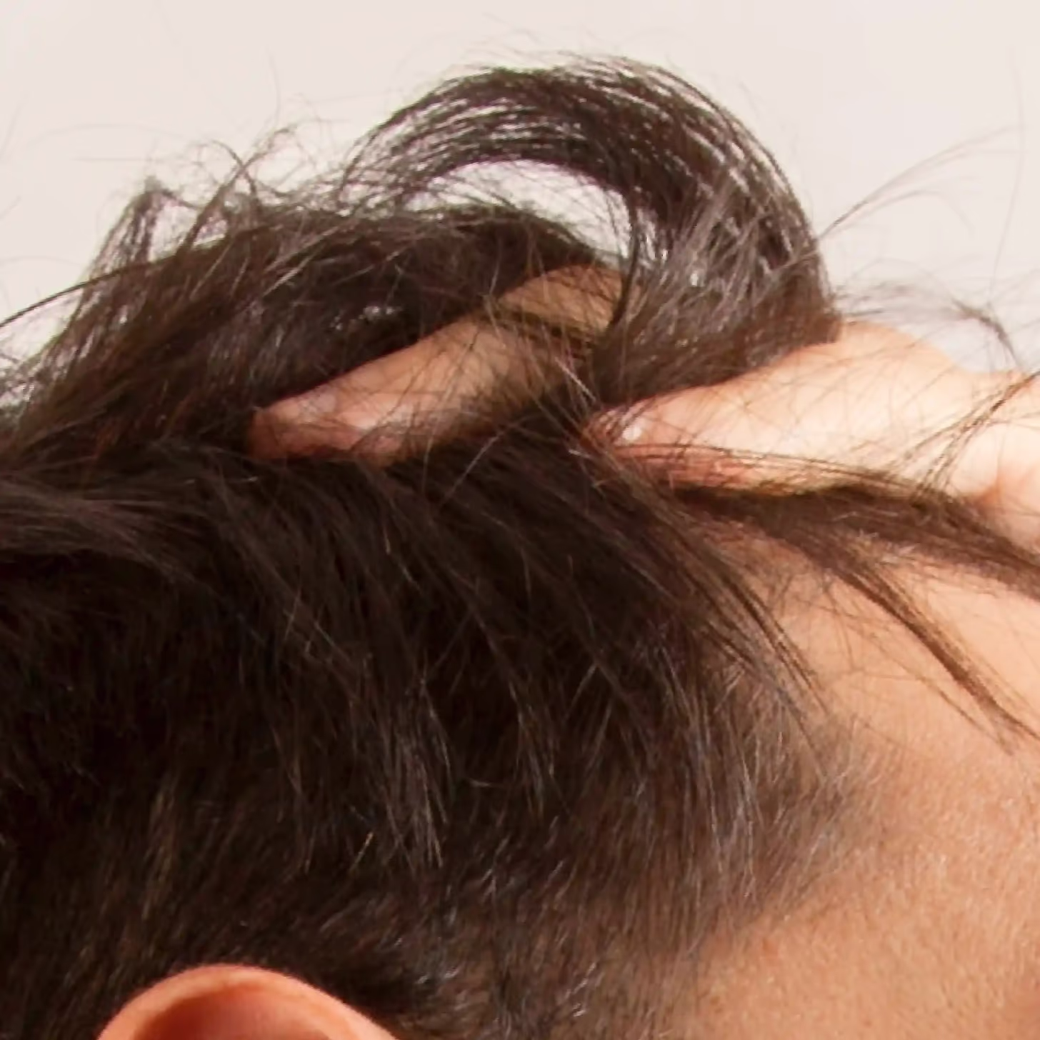 Who is a good candidate for Mesotherapy?