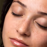 Tear trough filler with hyaluronic acid