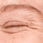Eliminate expression lines: Look 10 years younger
